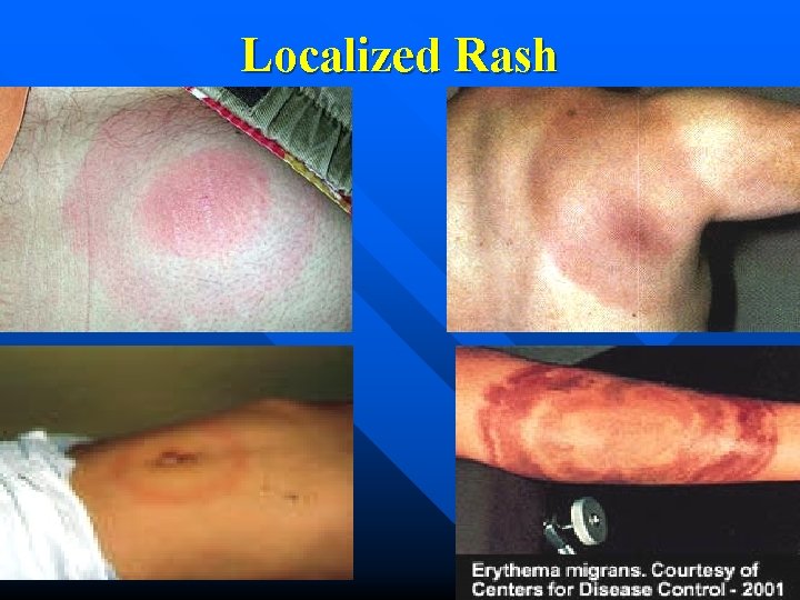 Localized Rash 