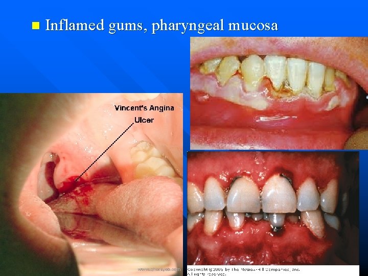 n Inflamed gums, pharyngeal mucosa 