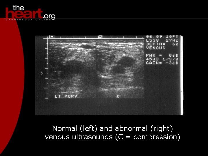 Normal (left) and abnormal (right) venous ultrasounds (C = compression) 