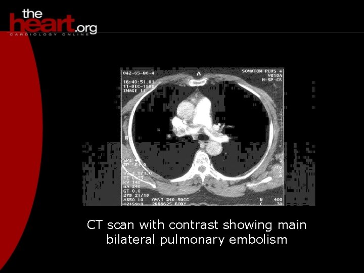 CT scan with contrast showing main bilateral pulmonary embolism 