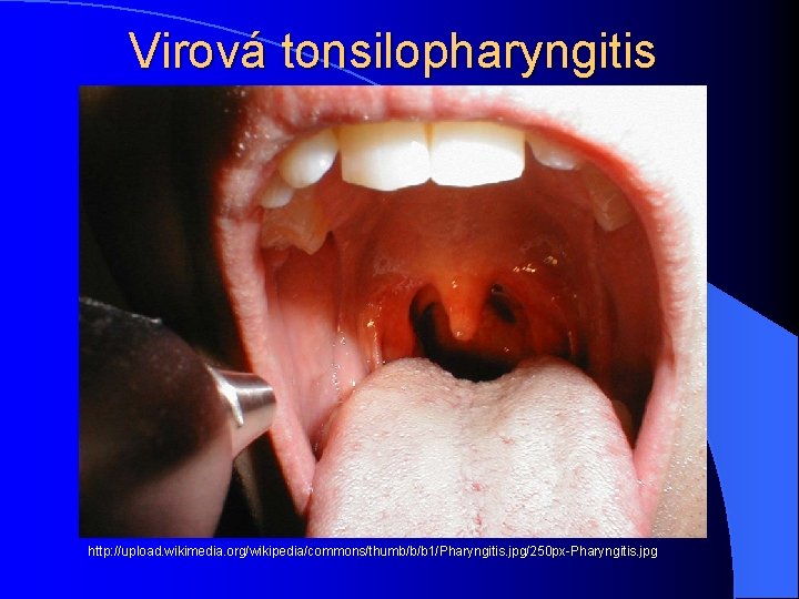 Virová tonsilopharyngitis http: //upload. wikimedia. org/wikipedia/commons/thumb/b/b 1/Pharyngitis. jpg/250 px-Pharyngitis. jpg 