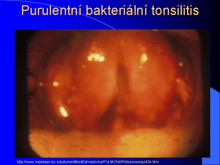 Purulentní bakteriální tonsilitis http: //www. meddean. luc. edu/lumen/Med. Ed/medicine/PULMONAR/diseases/pul 43 b. htm 