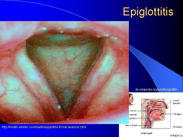 Epiglottitis de. wikipedia. org/wiki/Epiglottitis http: //health. allrefer. com/health/epiglottitis-throat-anatomy. html 