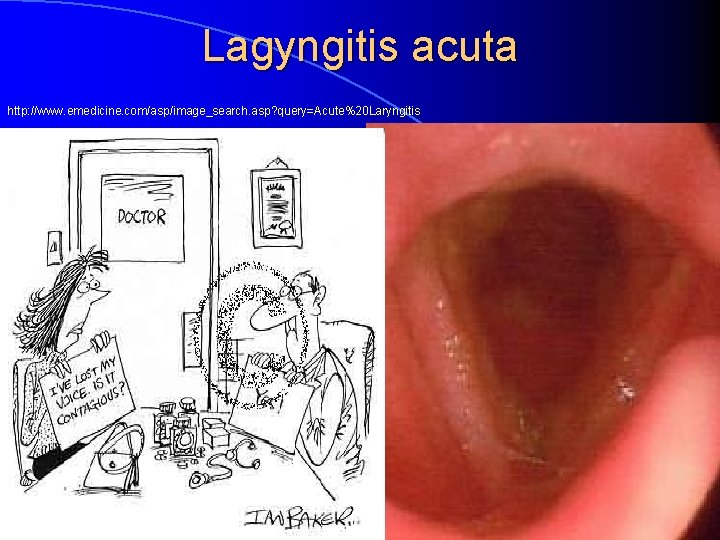 Lagyngitis acuta http: //www. emedicine. com/asp/image_search. asp? query=Acute%20 Laryngitis 