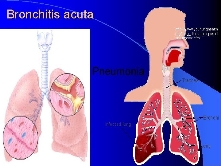 Bronchitis acuta http: //www. yourlunghealth. org/lung_disease/copd/nut shell/index. cfm http: //www. lhsc. on. ca/resptherapy/st udents/patho/brnchit