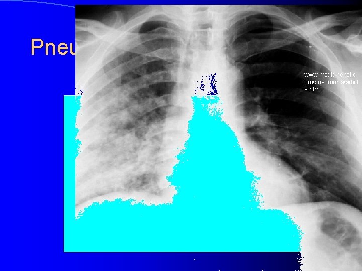 Pneumonie www. medicinenet. c om/pneumonia/articl e. htm 