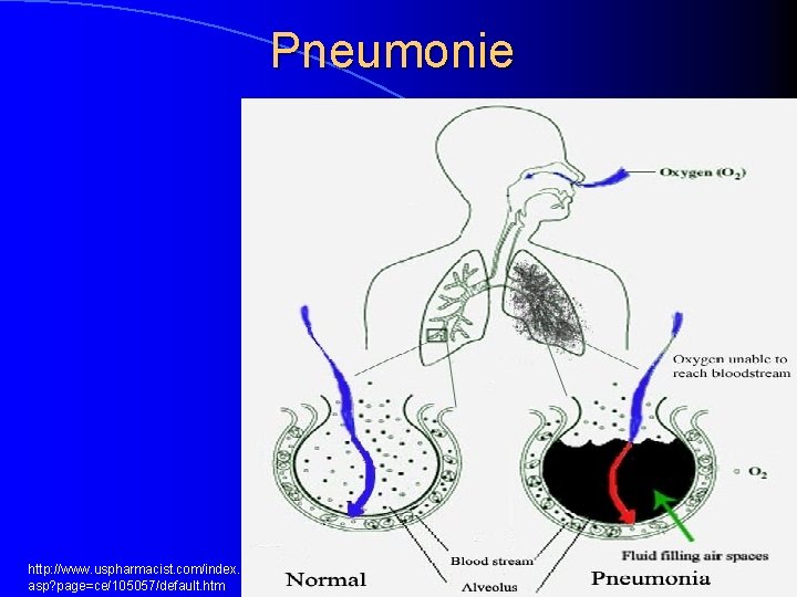 Pneumonie http: //www. uspharmacist. com/index. asp? page=ce/105057/default. htm 