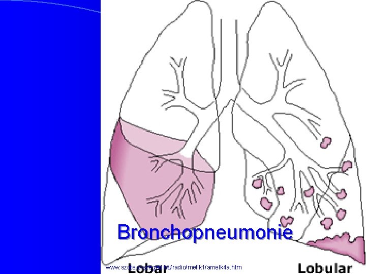 Bronchopneumonie www. szote. u-szeged. hu/radio/mellk 1/amelk 4 a. htm 