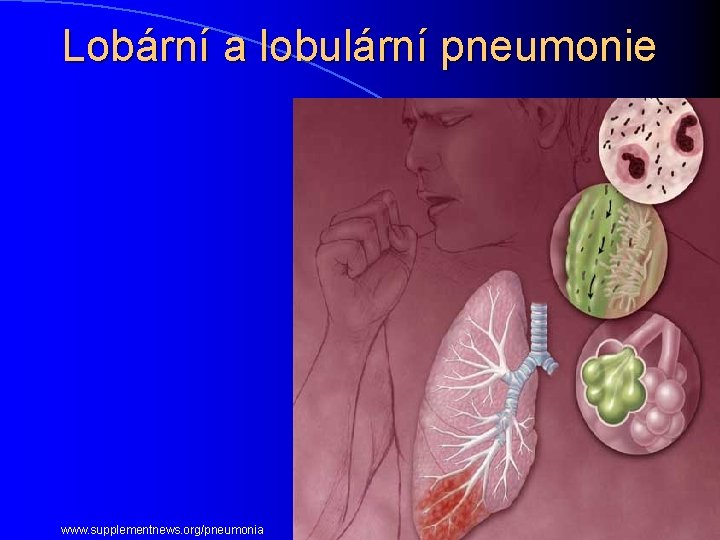 Lobární a lobulární pneumonie www. supplementnews. org/pneumonia 