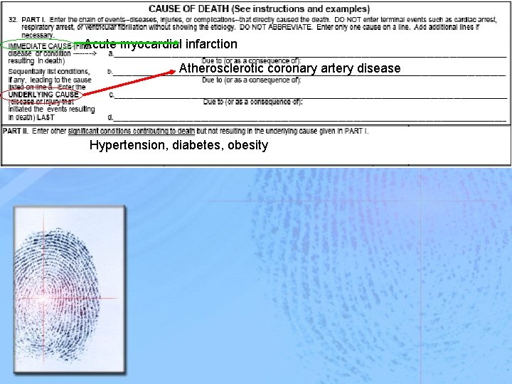 Acute myocardial infarction Atherosclerotic coronary artery disease Hypertension, diabetes, obesity 