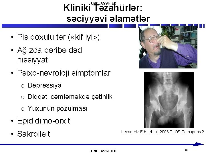 UNCLASSIFIED Kliniki Təzahürlər: səciyyəvi əlamətlər • Pis qoxulu tər ( «kif iyi» ) •