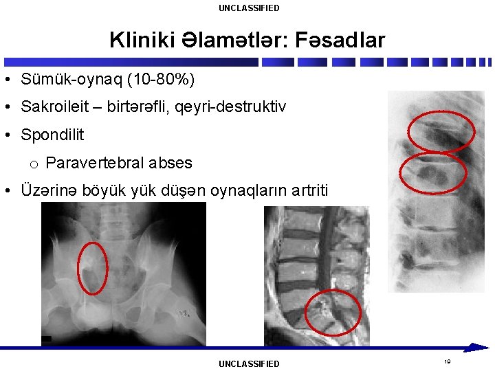 UNCLASSIFIED Kliniki Əlamətlər: Fəsadlar • Sümük-oynaq (10 -80%) • Sakroileit – birtərəfli, qeyri-destruktiv •