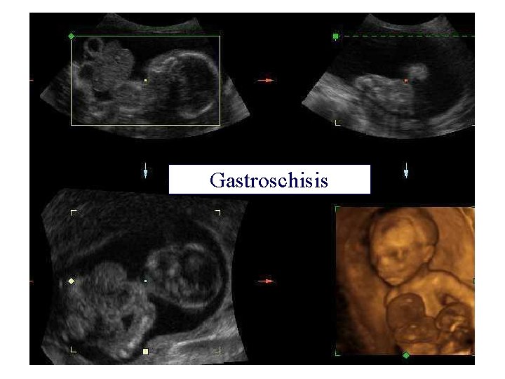 Gastroschisis 