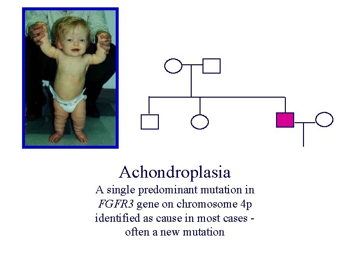 Achondroplasia A single predominant mutation in FGFR 3 gene on chromosome 4 p identified