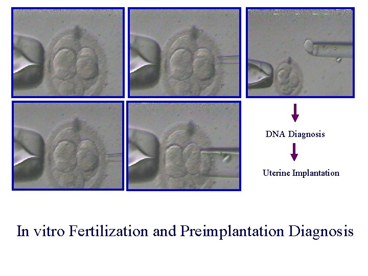DNA Diagnosis Uterine Implantation In vitro Fertilization and Preimplantation Diagnosis 