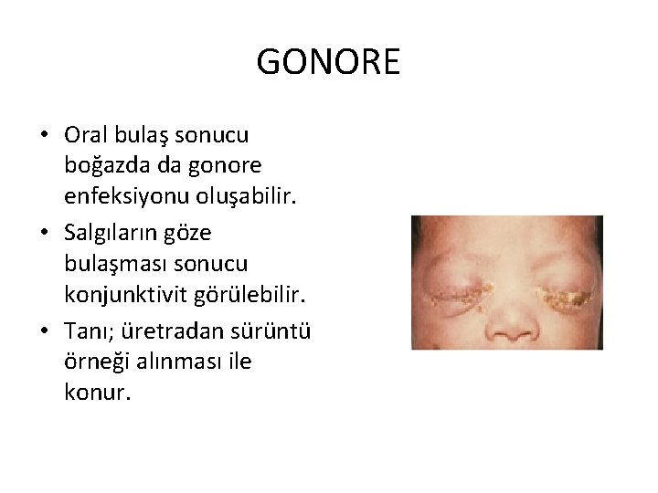 GONORE • Oral bulaş sonucu boğazda da gonore enfeksiyonu oluşabilir. • Salgıların göze bulaşması