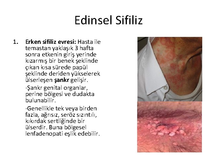 Edinsel Sifiliz 1. Erken sifiliz evresi: Hasta ile temastan yaklaşık 3 hafta sonra etkenin