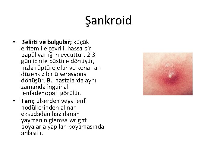 Şankroid • Belirti ve bulgular; küçük eritem ile çevrili, hassa bir papül varlığı mevcuttur.