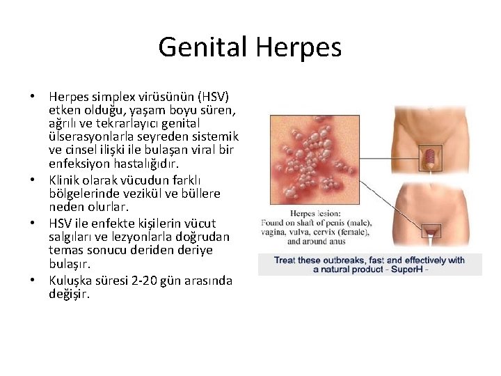 Genital Herpes • Herpes simplex virüsünün (HSV) etken olduğu, yaşam boyu süren, ağrılı ve