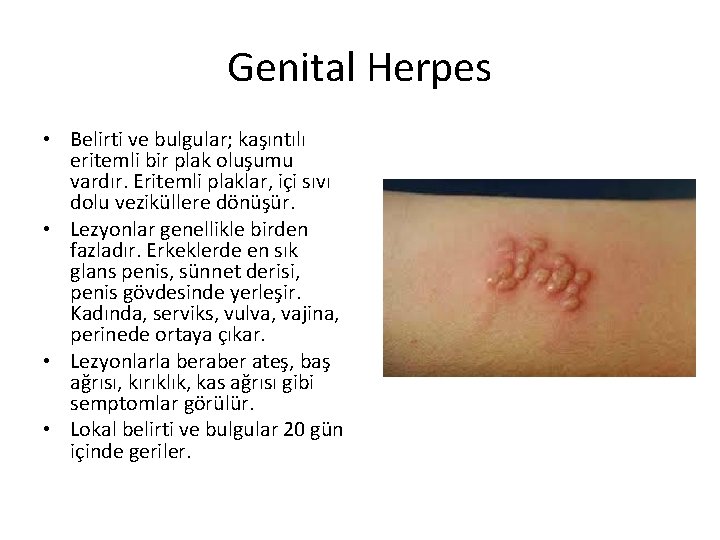 Genital Herpes • Belirti ve bulgular; kaşıntılı eritemli bir plak oluşumu vardır. Eritemli plaklar,