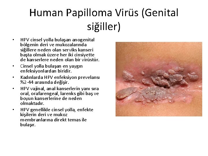 Human Papilloma Virüs (Genital siğiller) • • • HPV cinsel yolla bulaşan anogenital bölgenin