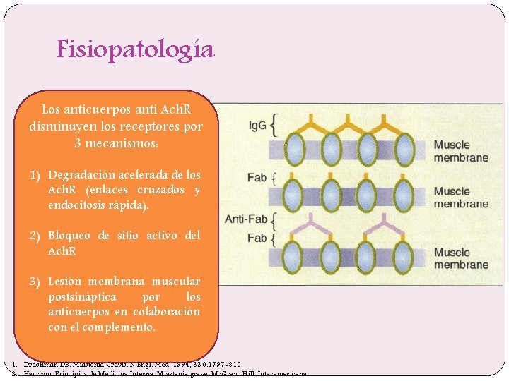 Fisiopatología Los anticuerpos anti Ach. R disminuyen los receptores por Los 3 anticuerpos mecanismos: