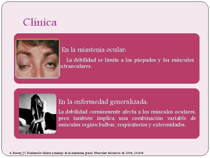Clínica En la miastenia ocular: La debilidad se limita a los párpados y los