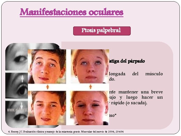 Manifestaciones oculares Ptosis palpebral • • - Examen para la fatiga del párpado •