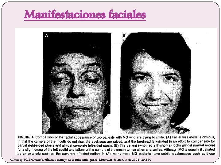 Manifestaciones faciales � Debilidad facial puede ocurrir en la MG sin afectación ocular, pero