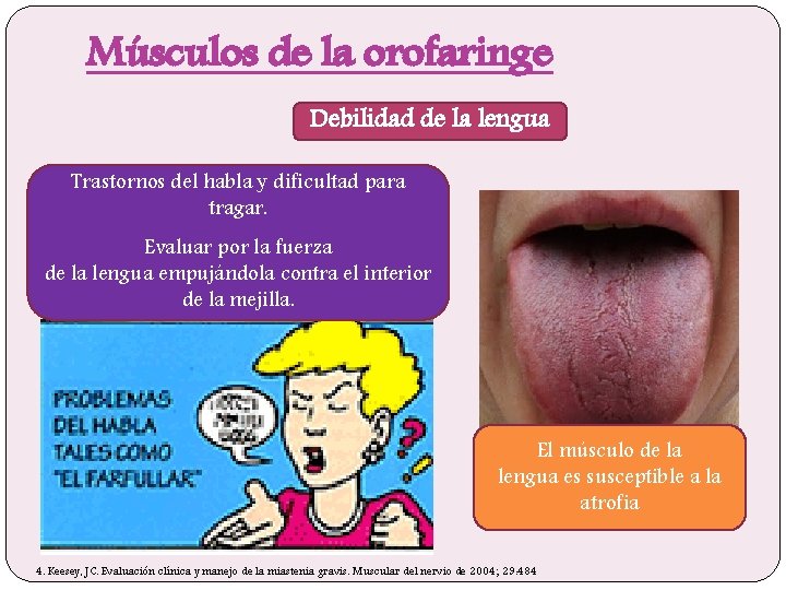 Músculos de la orofaringe Debilidad de la lengua Trastornos del habla y dificultad para