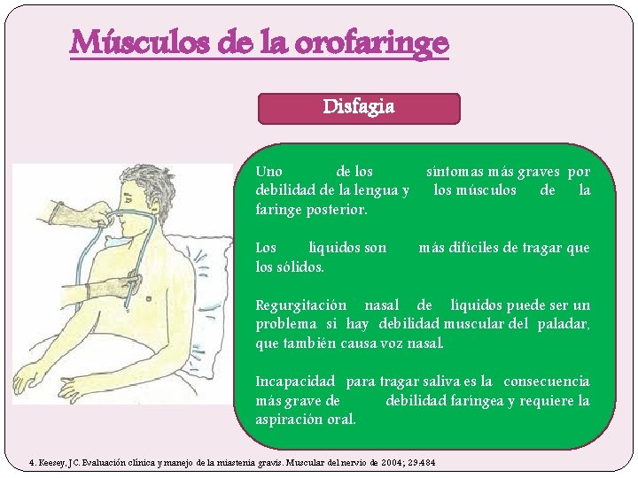 Músculos de la orofaringe Disfagia Uno de los debilidad de la lengua y faringe