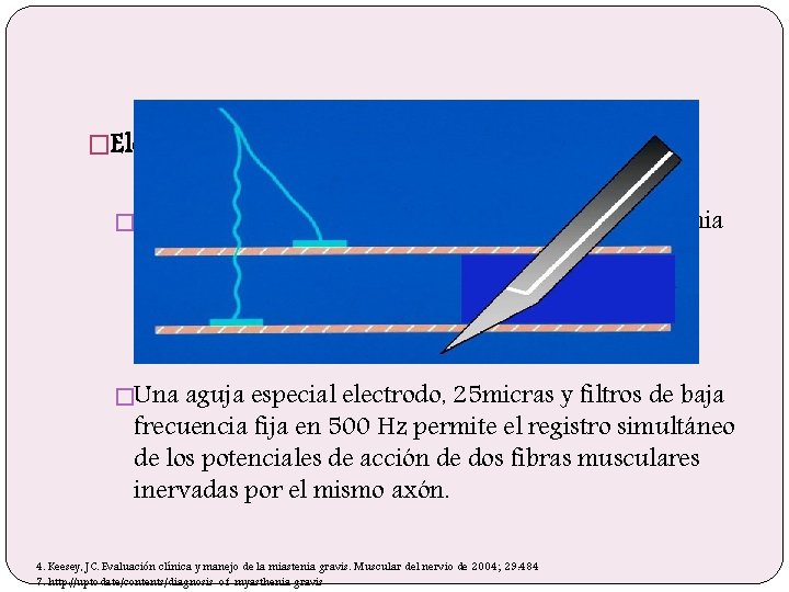 �Electromiografía de fibra única �Es la prueba diagnóstica más sensible para la miastenia gravis.