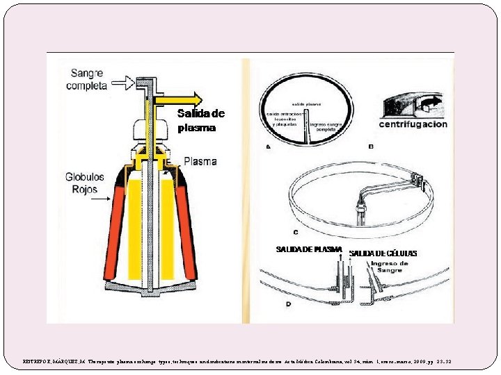 RESTREPO E, MÁRQUEZ, M. Therapeutic plasma exchange: types, techniques and indications in internal medicine.