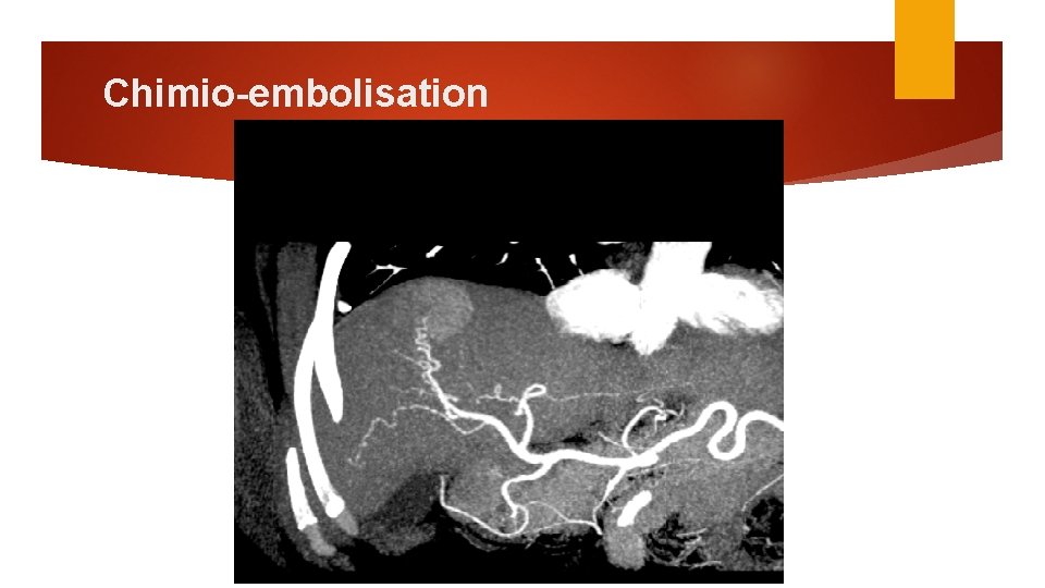 Chimio-embolisation 