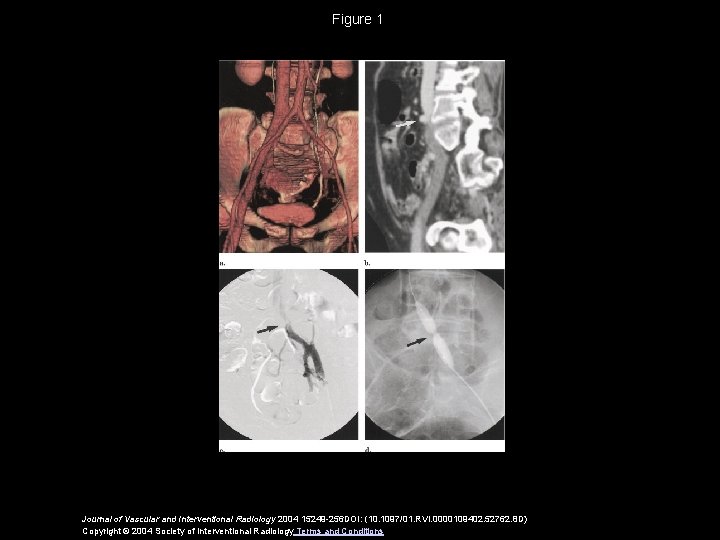 Figure 1 Journal of Vascular and Interventional Radiology 2004 15249 -256 DOI: (10. 1097/01.