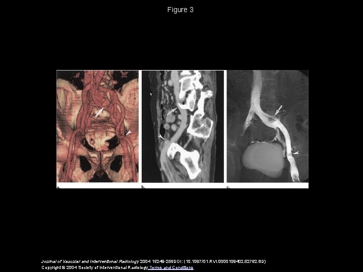 Figure 3 Journal of Vascular and Interventional Radiology 2004 15249 -256 DOI: (10. 1097/01.