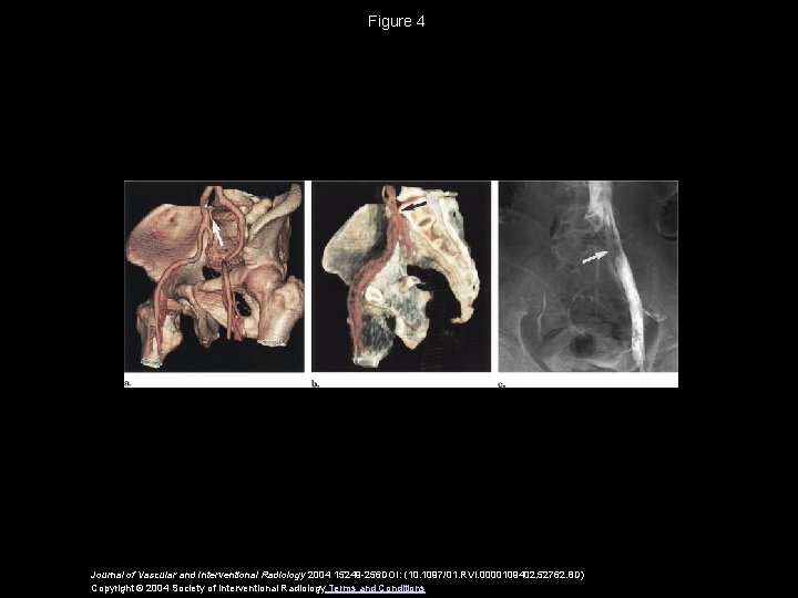 Figure 4 Journal of Vascular and Interventional Radiology 2004 15249 -256 DOI: (10. 1097/01.
