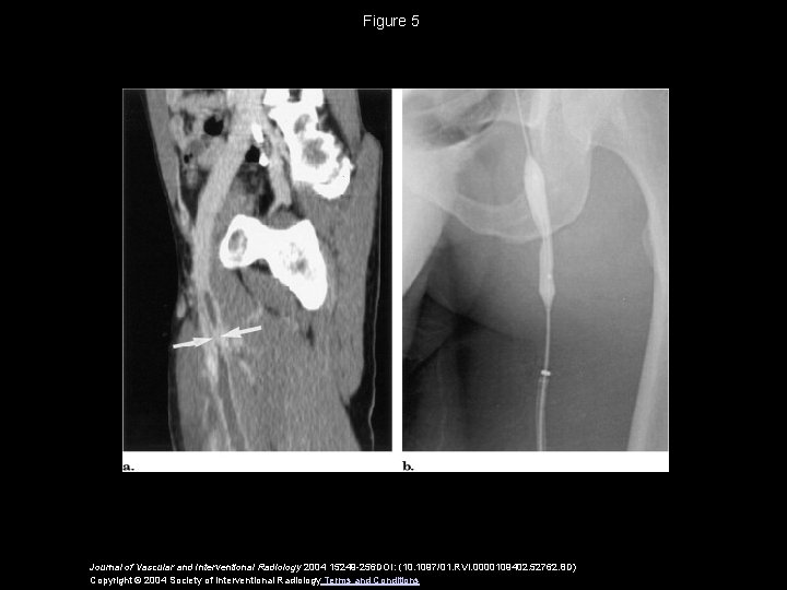 Figure 5 Journal of Vascular and Interventional Radiology 2004 15249 -256 DOI: (10. 1097/01.