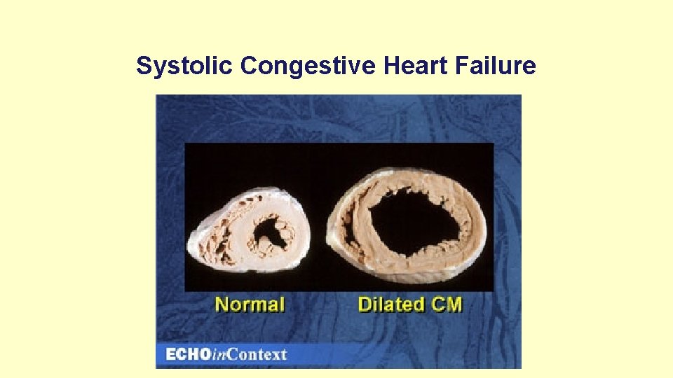 Systolic Congestive Heart Failure 