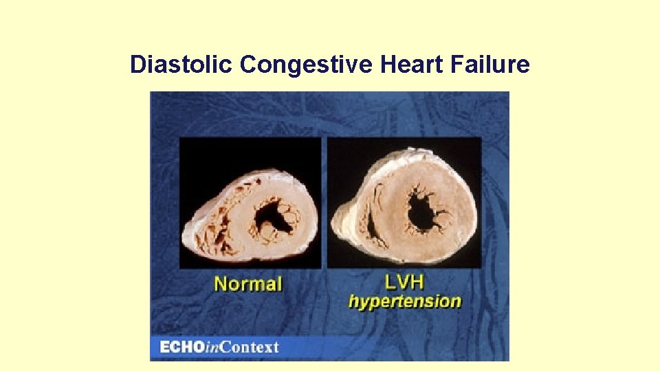 Diastolic Congestive Heart Failure 