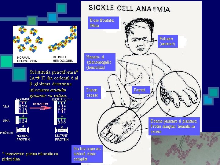 Bose frontale; febra Paloare (anemie) Substitutia punctiforma* (A T) din codonul 6 al β–globinei