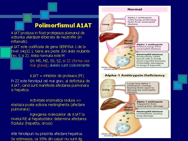 Polimorfismul A 1 AT produsa in ficat protejeaza plamanul de actiunea elastazei eliberata de