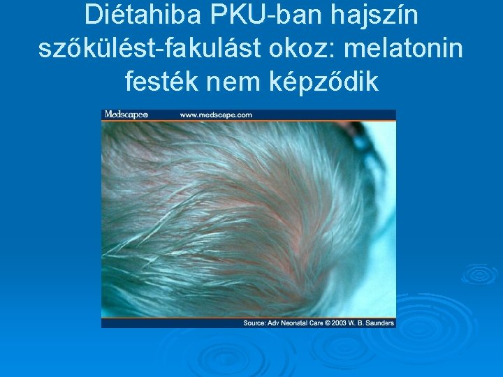 Diétahiba PKU-ban hajszín szőkülést-fakulást okoz: melatonin festék nem képződik 