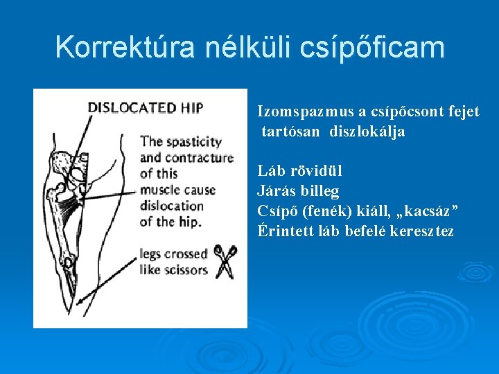 Korrektúra nélküli csípőficam Izomspazmus a csípőcsont fejet tartósan diszlokálja Láb rövidül Járás billeg Csípő