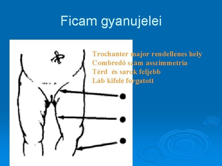 Ficam gyanujelei Trochanter major rendellenes hely Combredő szám asszimmetria Térd és sarok feljebb Láb