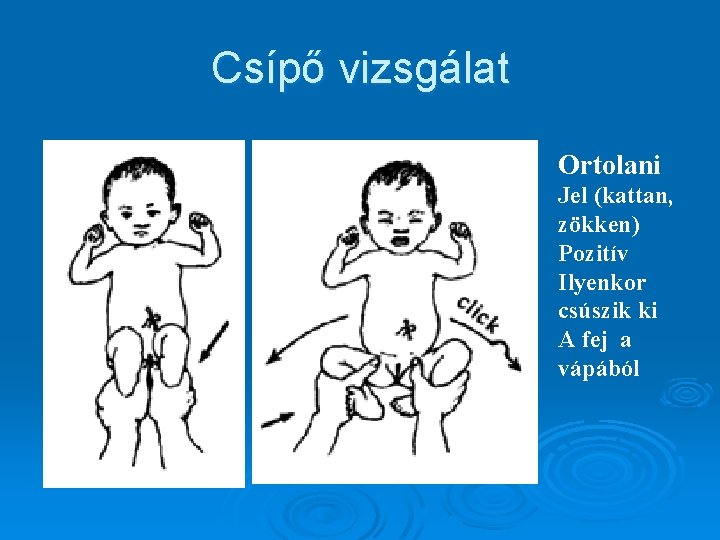 Csípő vizsgálat Ortolani Jel (kattan, zökken) Pozitív Ilyenkor csúszik ki A fej a vápából