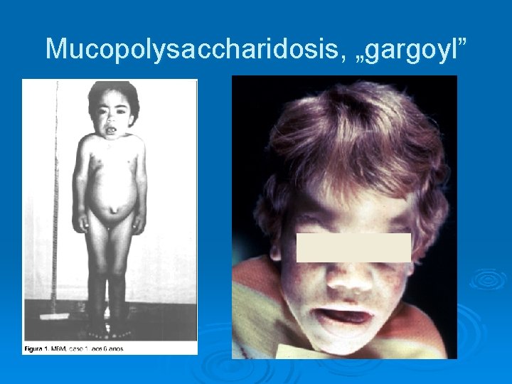 Mucopolysaccharidosis, „gargoyl” 