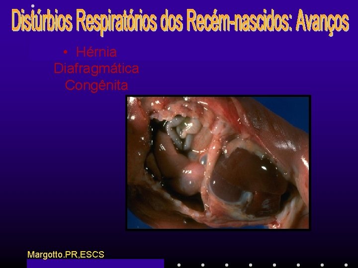  • Hérnia Diafragmática Congênita Margotto. PR, ESCS 