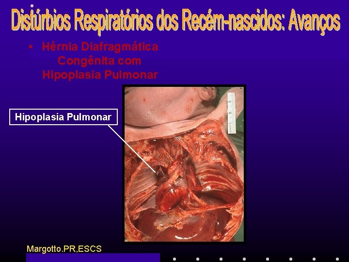  • Hérnia Diafragmática Congênita com Hipoplasia Pulmonar Margotto. PR, ESCS 