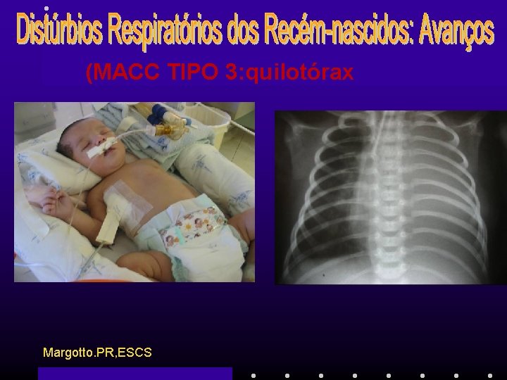 (MACC TIPO 3: quilotórax Margotto. PR, ESCS 